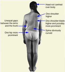 scoliosis-posture